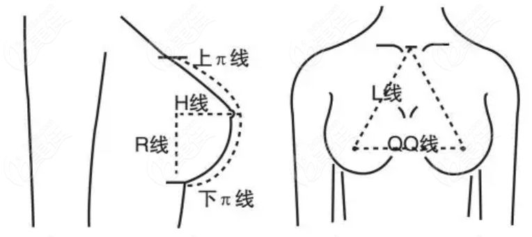 隆胸手术术前画线图片