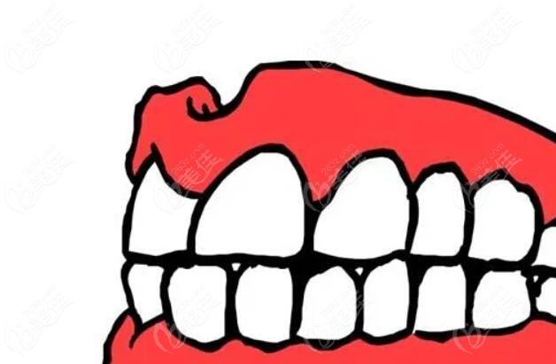 成都镶全口假牙要花多少钱以老人装全口种植牙价格为例讲讲