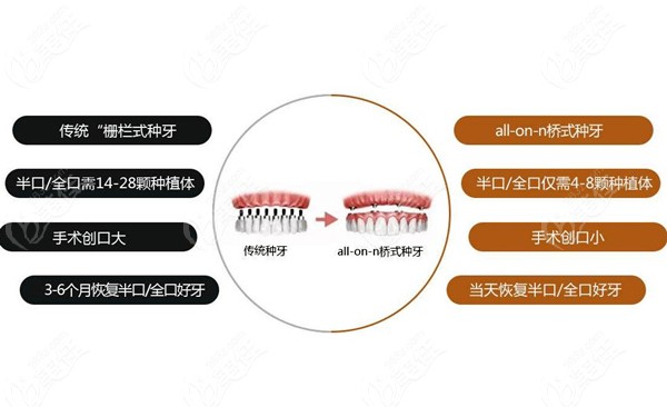 传统种牙和all on 4种牙的区别
