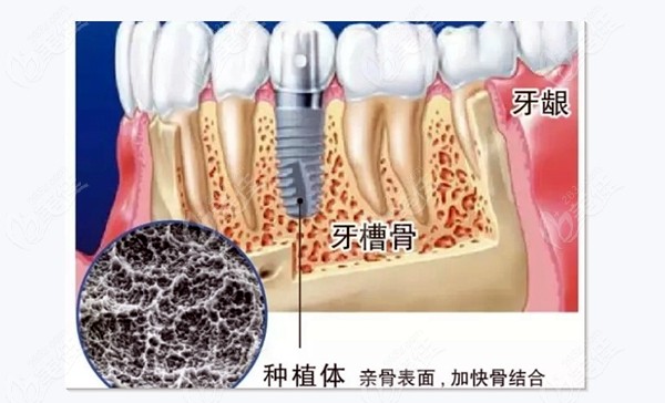 种植体在牙槽骨内的图