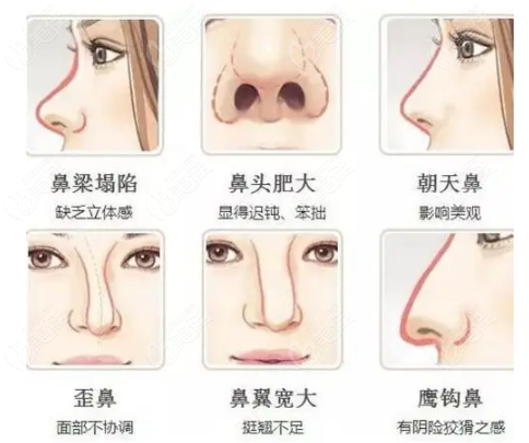 什么样的鼻子需要做鼻综合整形
