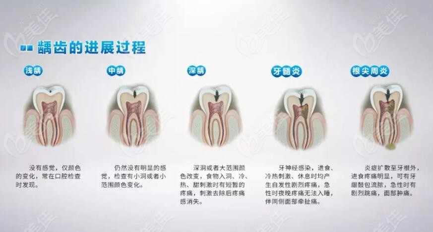 一般龋齿有五个阶段,分别是浅龋,中龋,深龋,牙髓炎和根尖周炎