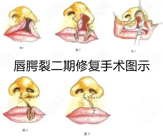 腭裂修复术术示意图图片