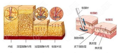 吸脂手术瘦身的原理图