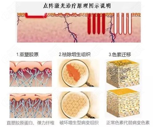 點(diǎn)陣激光治療疤痕的原理 點(diǎn)陣激光治療疤痕的原理