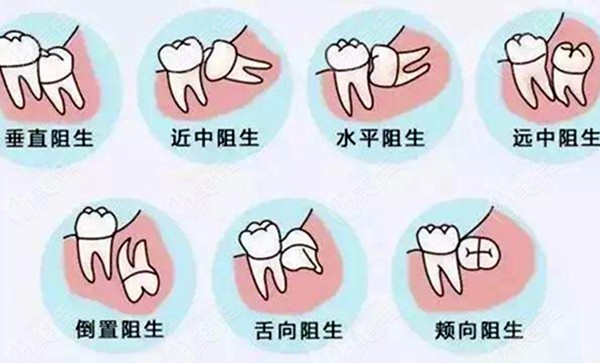 阻生牙的分类图片图片