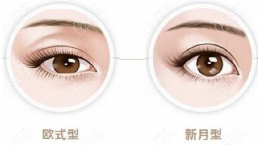 张林宏医生可以做的双眼皮类型