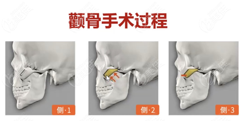 削颧骨手术过程图