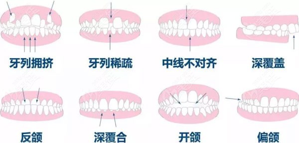 隐适美牙套越多价格越高。