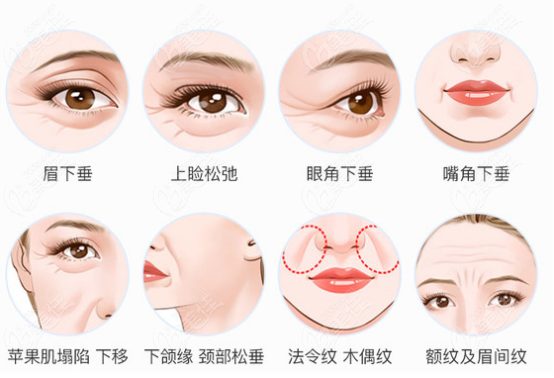 面部哪些问题可以做拉皮手术
