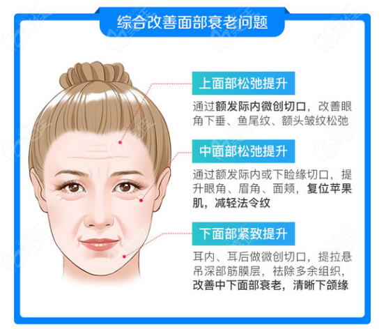 拉皮手术可以改善面部哪些问题