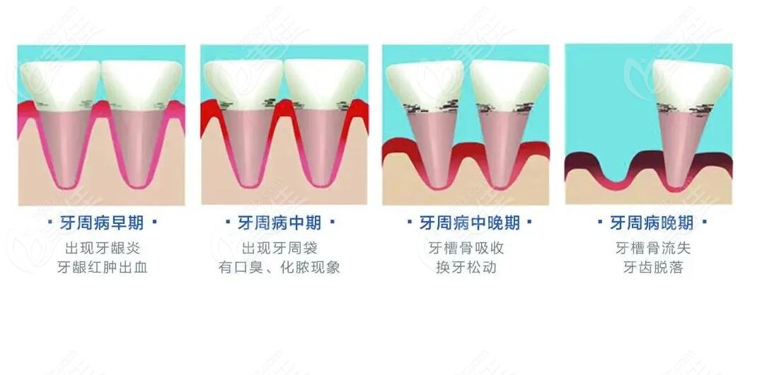 牙周病几个程度