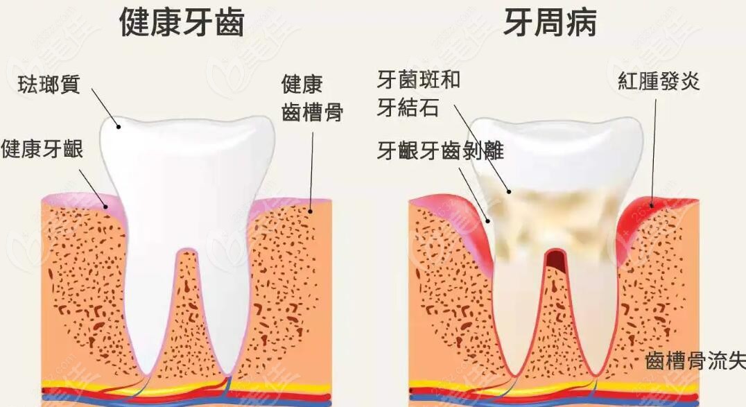 健康牙齿和牙周病牙齿对比