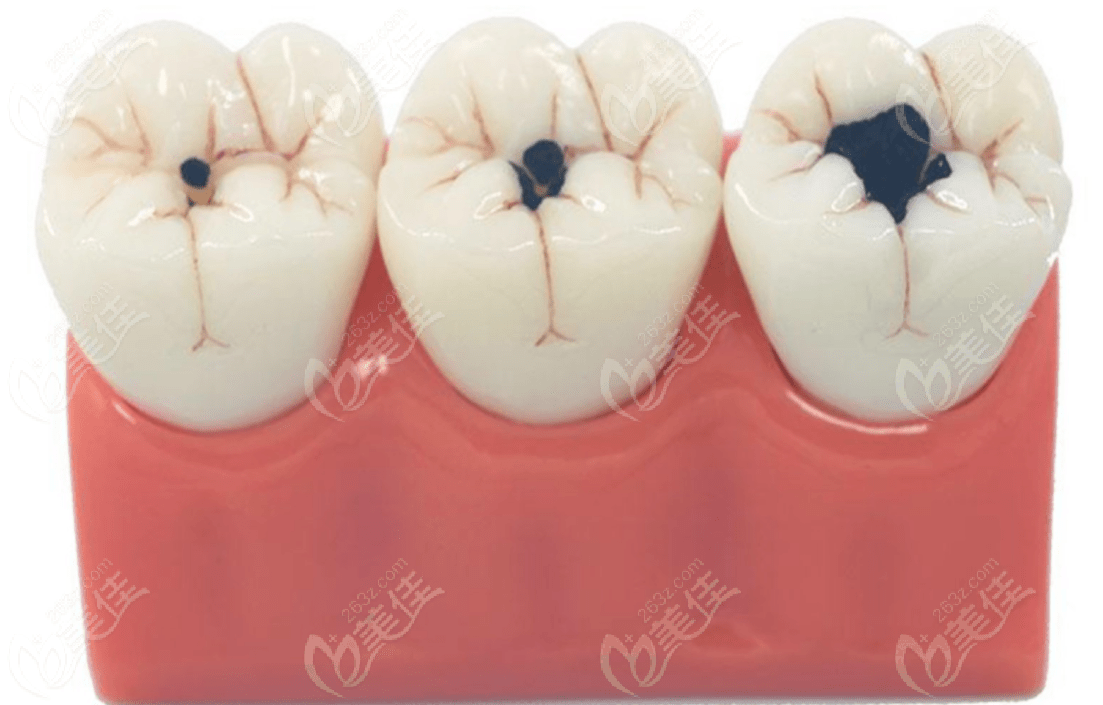 牙齿龋坏的演变过程