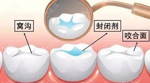 减少患蛀牙的措施