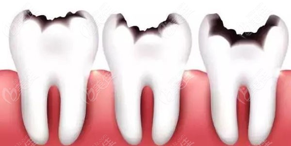 治疗蛀牙的方法是补牙