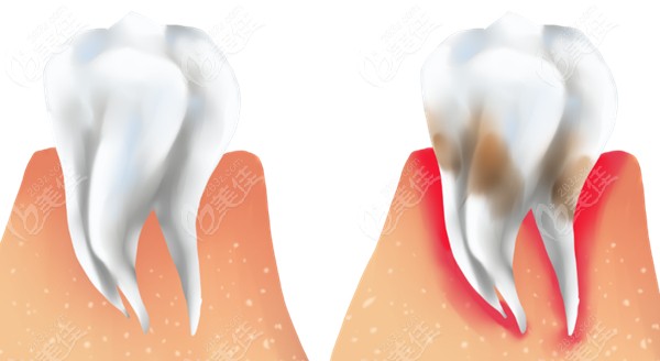 为什么做种植牙之前需要先治疗牙周病