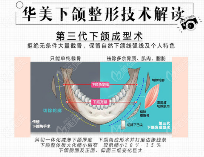 武汉华美付国友做下颌角手术优势