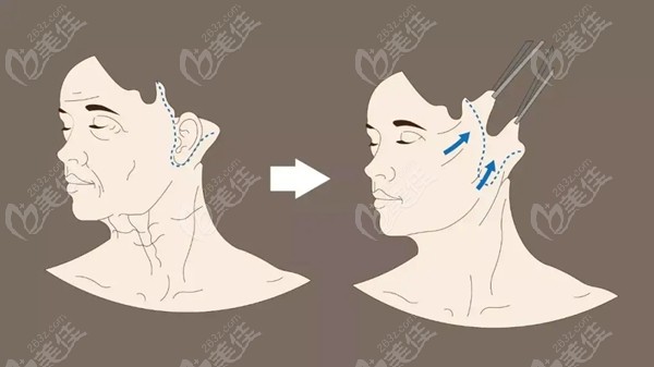 洛阳拉皮手术哪家医院做的好