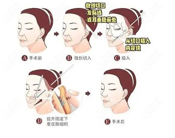 洛阳做拉皮手术好的医院名单