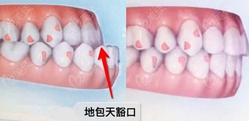 骨性地包天正颌正畸术后一年