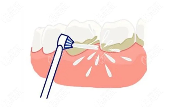 牙龈萎缩怎么治疗比较好呢