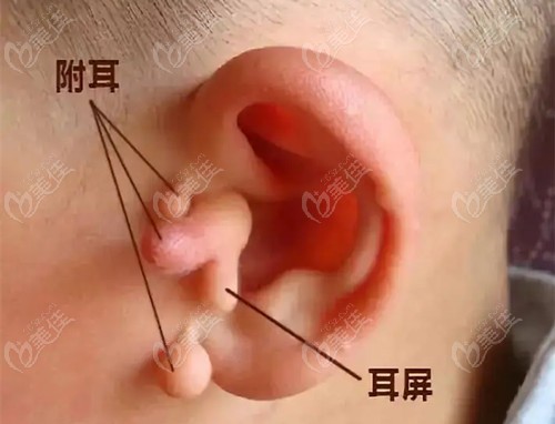 附耳的症状表现