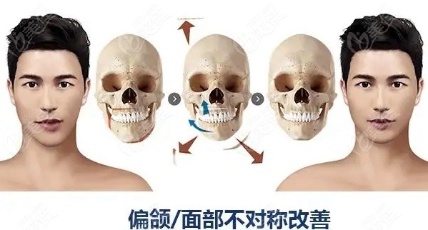 骨性偏颌做正颌手术矫正过程