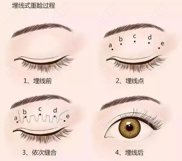 埋线双眼皮的手术过程