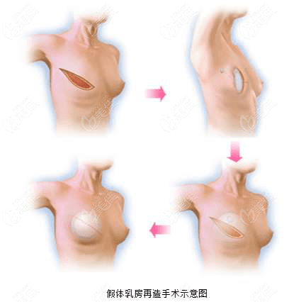 单侧假体乳房重建手术前后对比