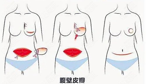 腹部皮瓣乳房重建过程