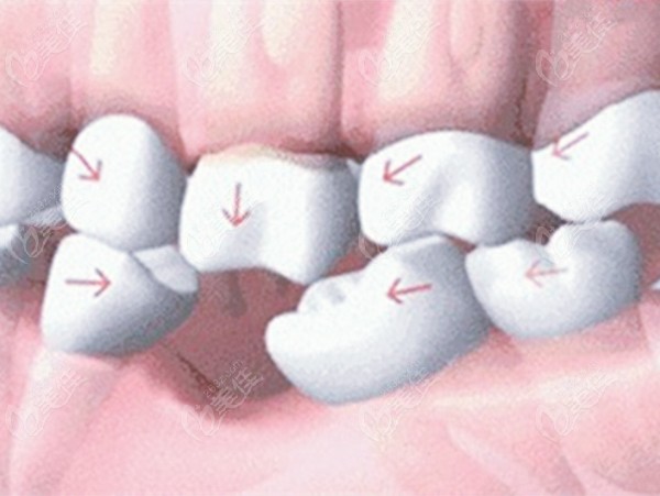 牙齿缺失后周围牙的情况