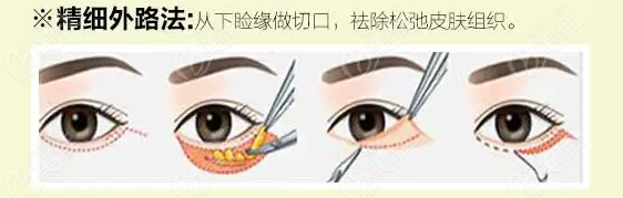 酒泉华美做外切祛眼袋手术过程