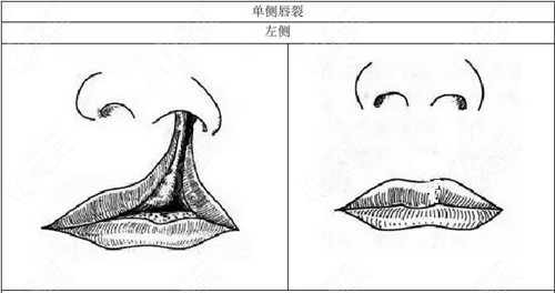 隐形唇裂术后图片对比图片