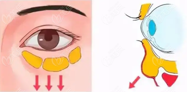 <!--<i data=20240703-sp></i>-->做祛眼袋过程