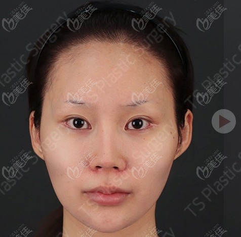 韩国TS鼻综合+颧骨+下颌角整形术前照
