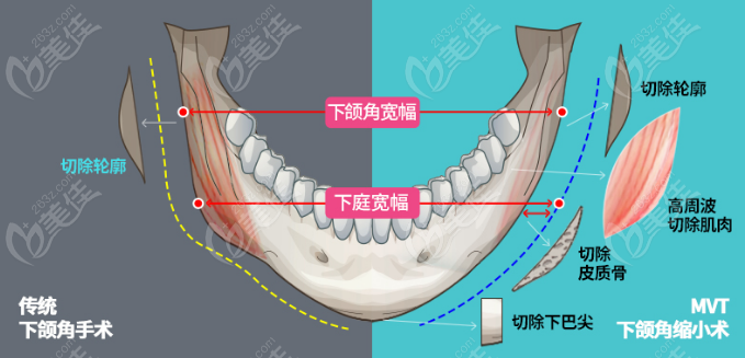 脸方又不敢削骨怎么办