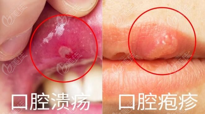 口腔溃疡和口腔疱疹的区别
