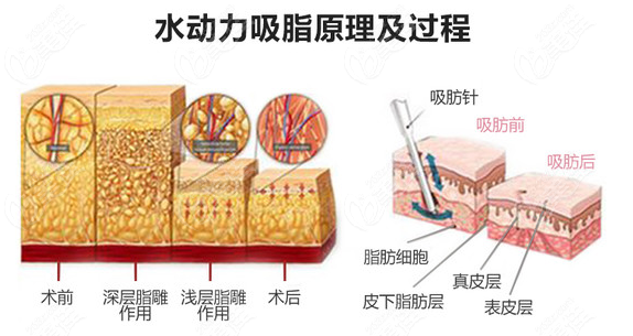 水动力全身吸脂优势