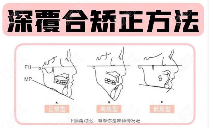 深覆合用平导还是支抗钉轻微深覆合及深覆合3度矫正方法不同