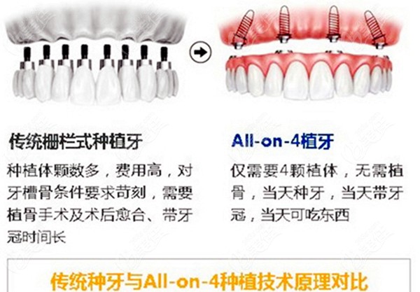 传统种植牙和all on 4植牙的区别