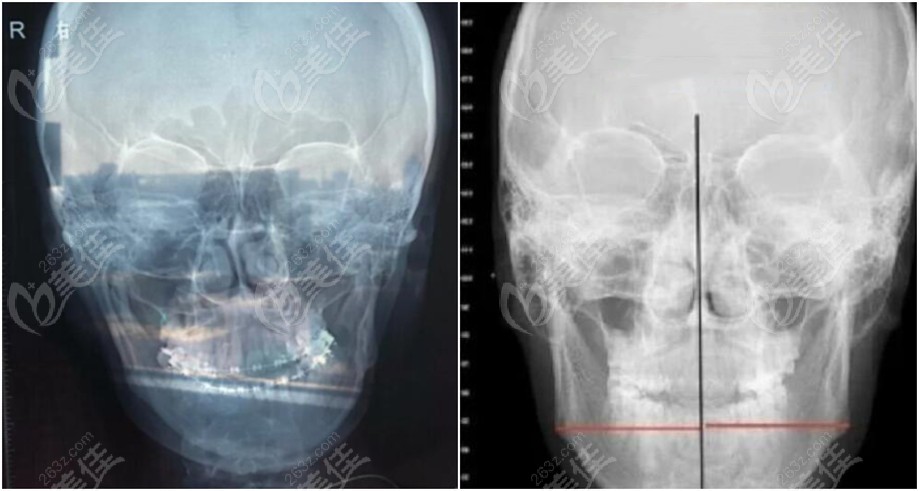 骨性偏颌3mm脸歪做正颌手术矫正变化照片