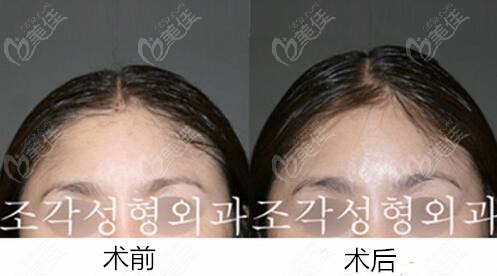 骨水泥填充顱頂真人前后對比照