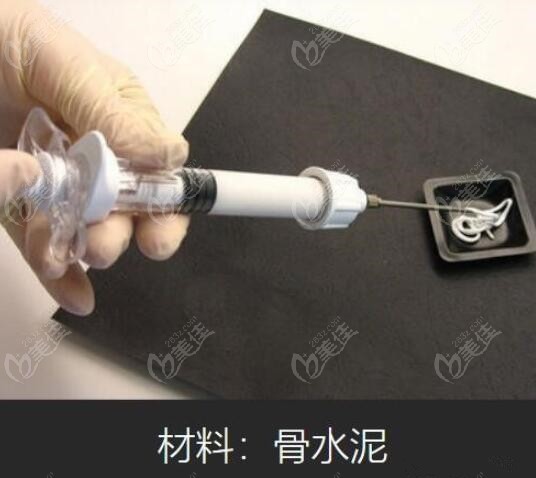 骨水泥填充顱頂手術(shù)