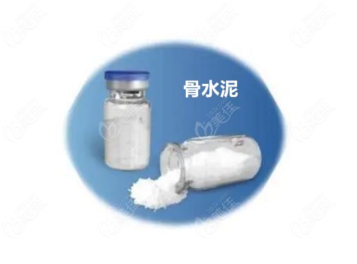 骨水泥填充顱頂手術(shù)安 全嗎