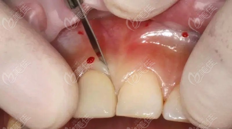 牙龈切除术适用于肥大性龈炎