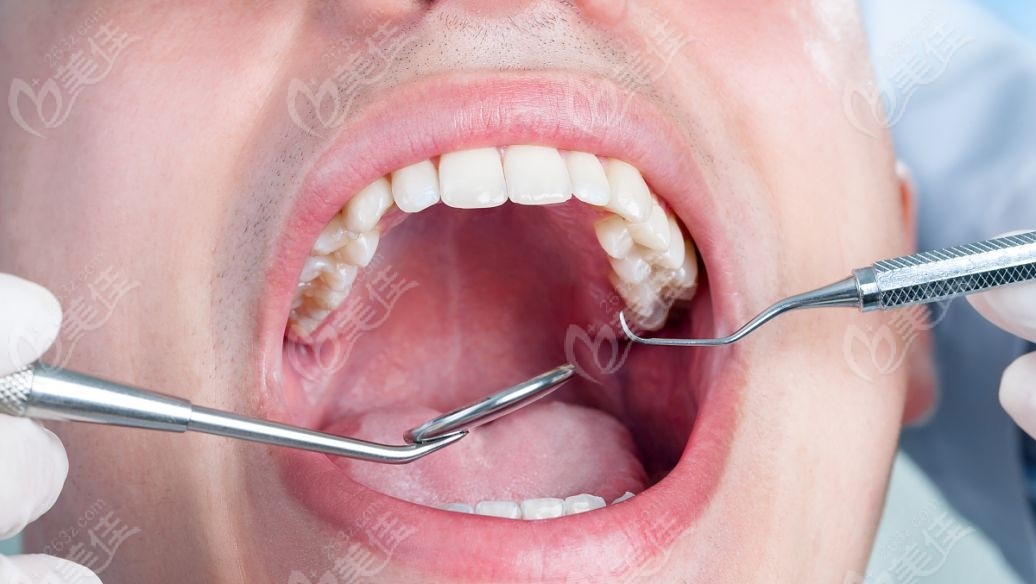 牙龈切除术千万不要做是怎么回事