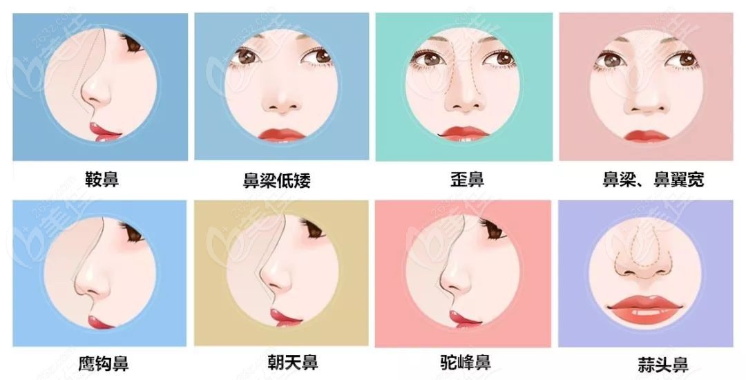 巫文云医生可以改善的鼻型