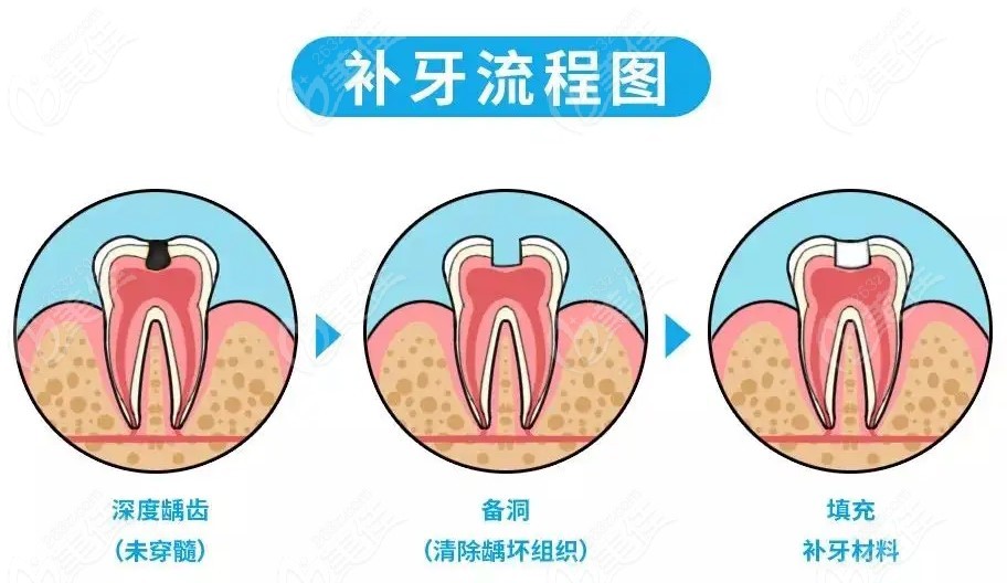 补牙的流程及步骤图片图片