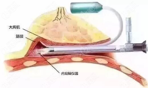 做一次蜜桃豐胸價格要多少錢